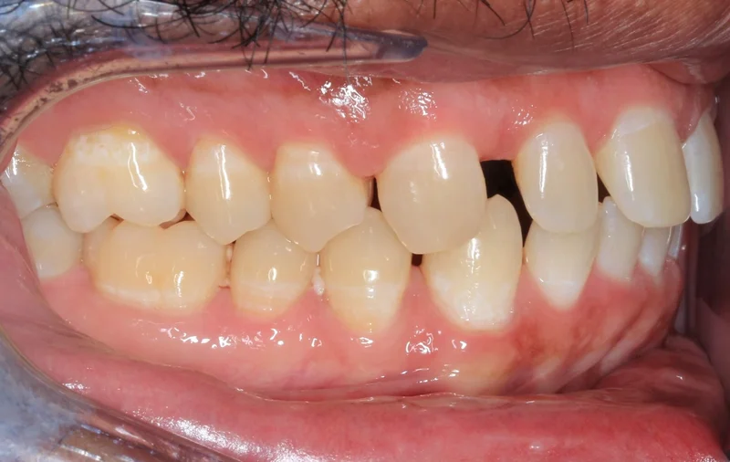 Right Buccal - Before Treatment