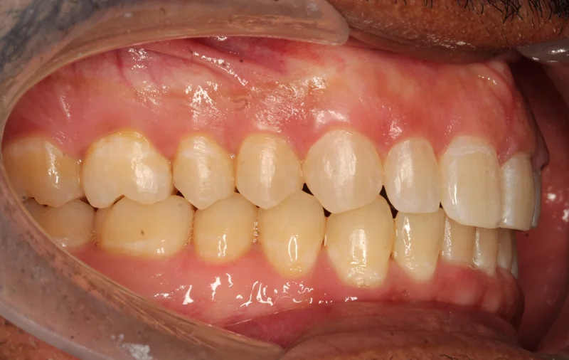 Right Buccal - After Treatment