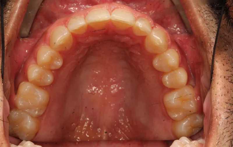 Upper - After Treatment