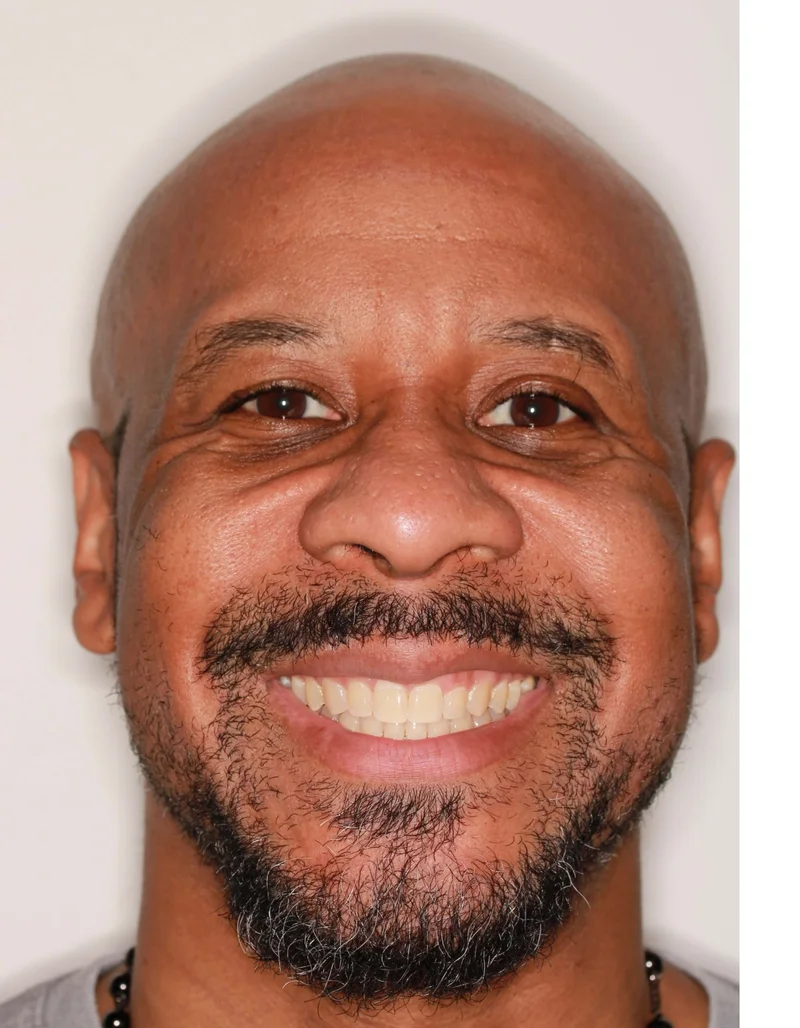 Front Facial Smiling - After Treatment