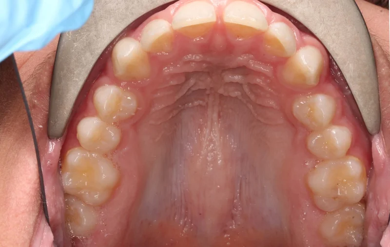 Upper - Before Treatment