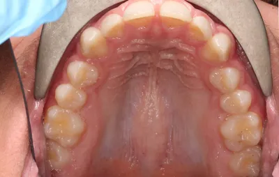 Before Clear Aligners treatment - Case 92728