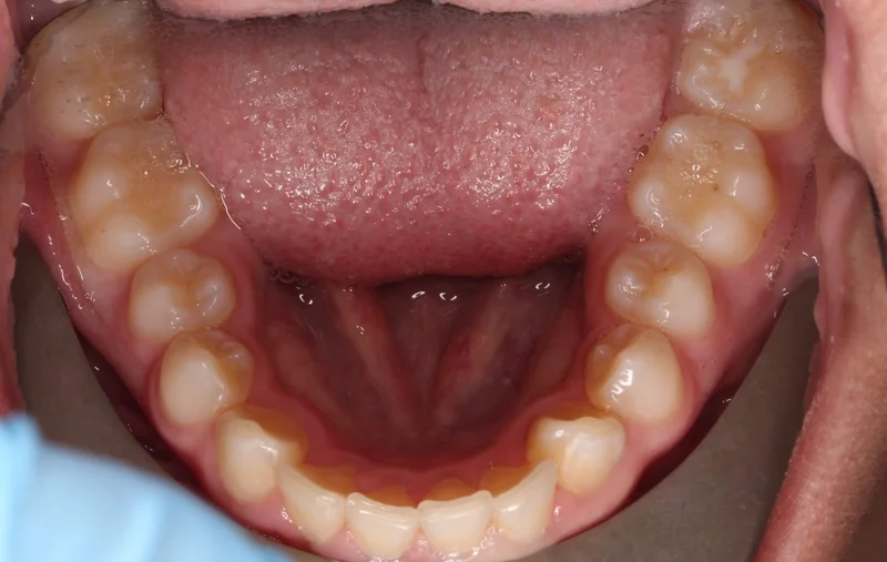 Lower - Before Treatment