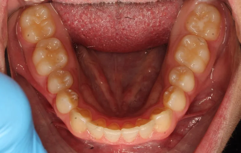 Lower - After Treatment