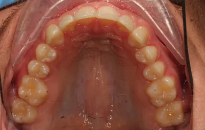 After Clear Aligners treatment - Case 92728