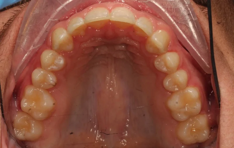 Upper - After Treatment