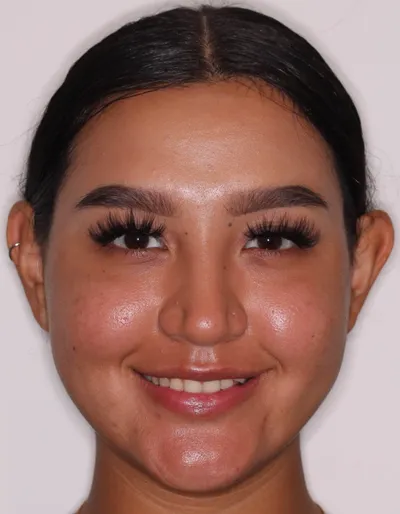 Before Clear Aligners treatment - Case 92737