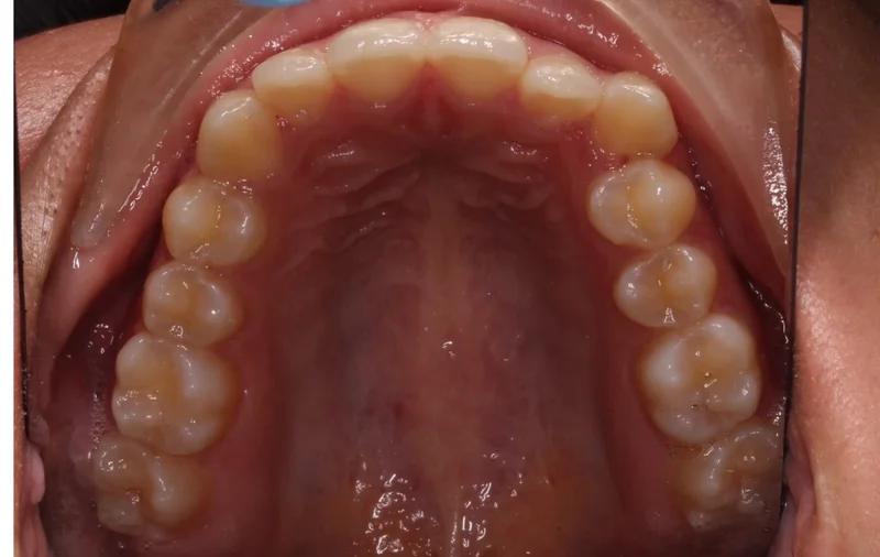 Upper - Before Treatment