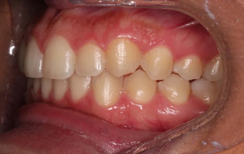 Left - After Treatment