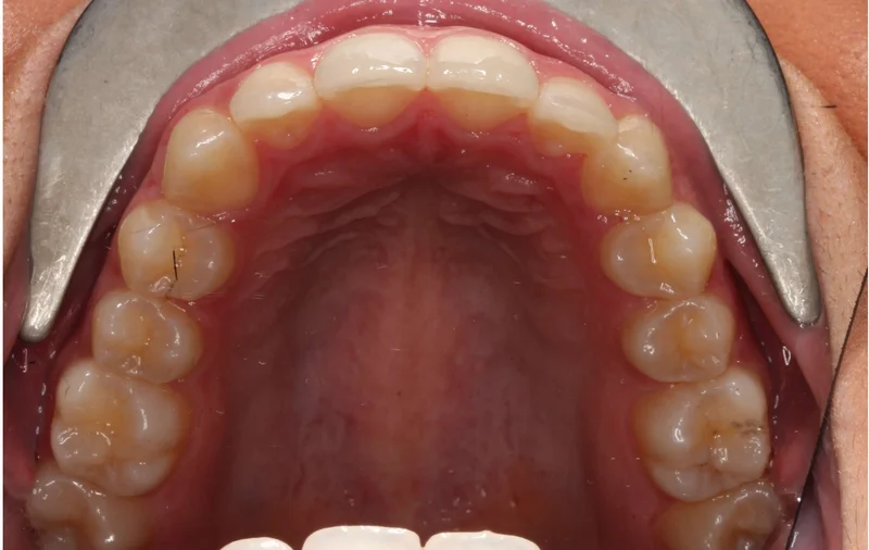 Upper - After Treatment