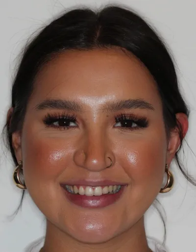 After Clear Aligners treatment - Case 92737