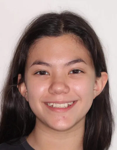 Before Metal Braces treatment - Case 94226