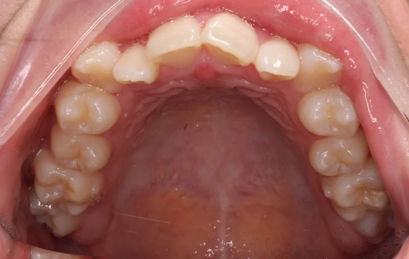 Upper Occlusal - Before Treatment