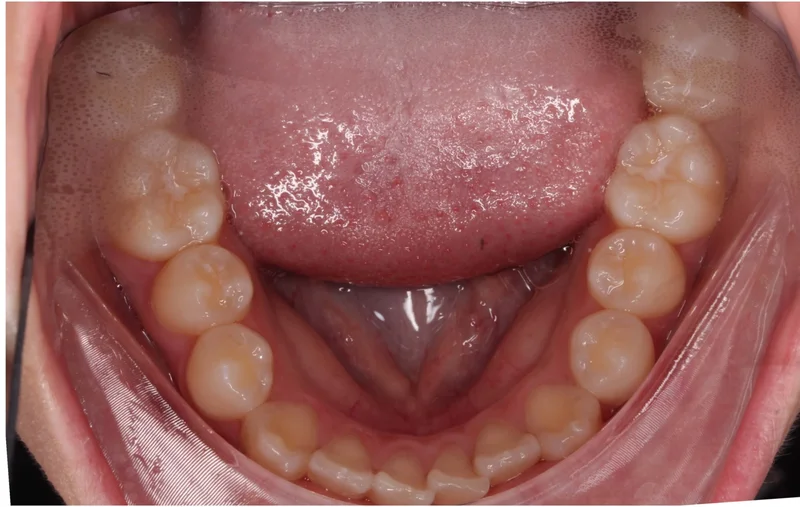 Lower Occlusal - Before Treatment
