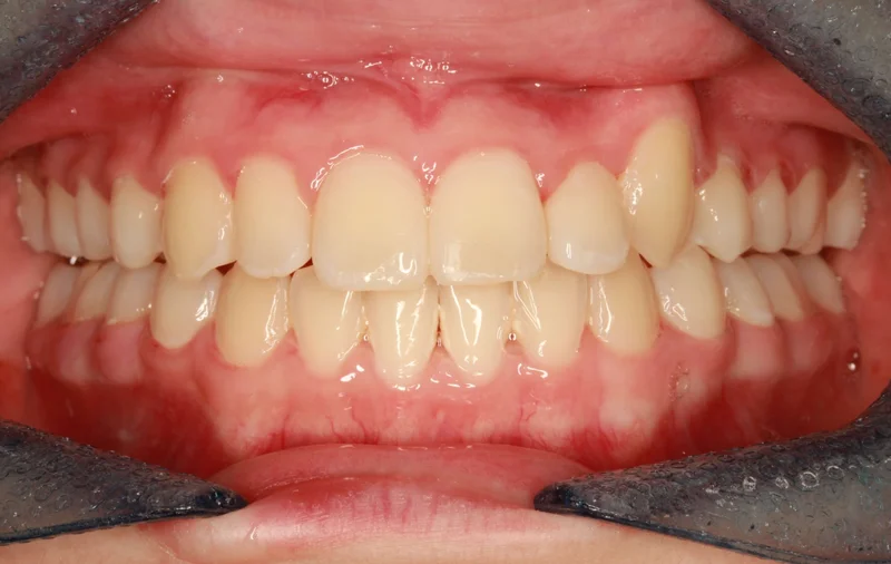 Center - After Treatment