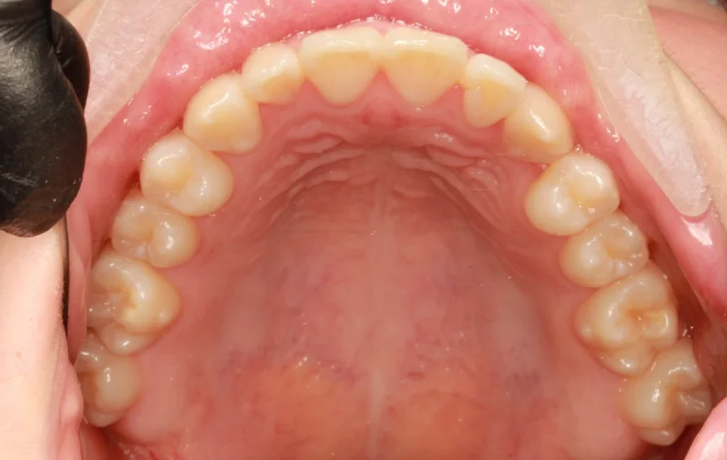 Upper Occlusal - After Treatment