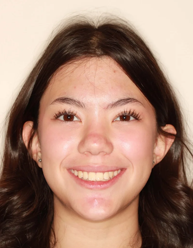 Center - After Treatment