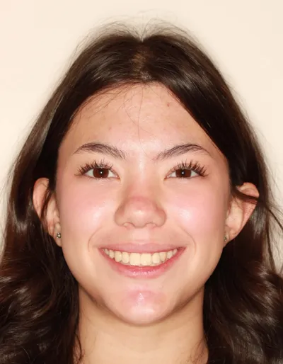 After Metal Braces treatment - Case 94226