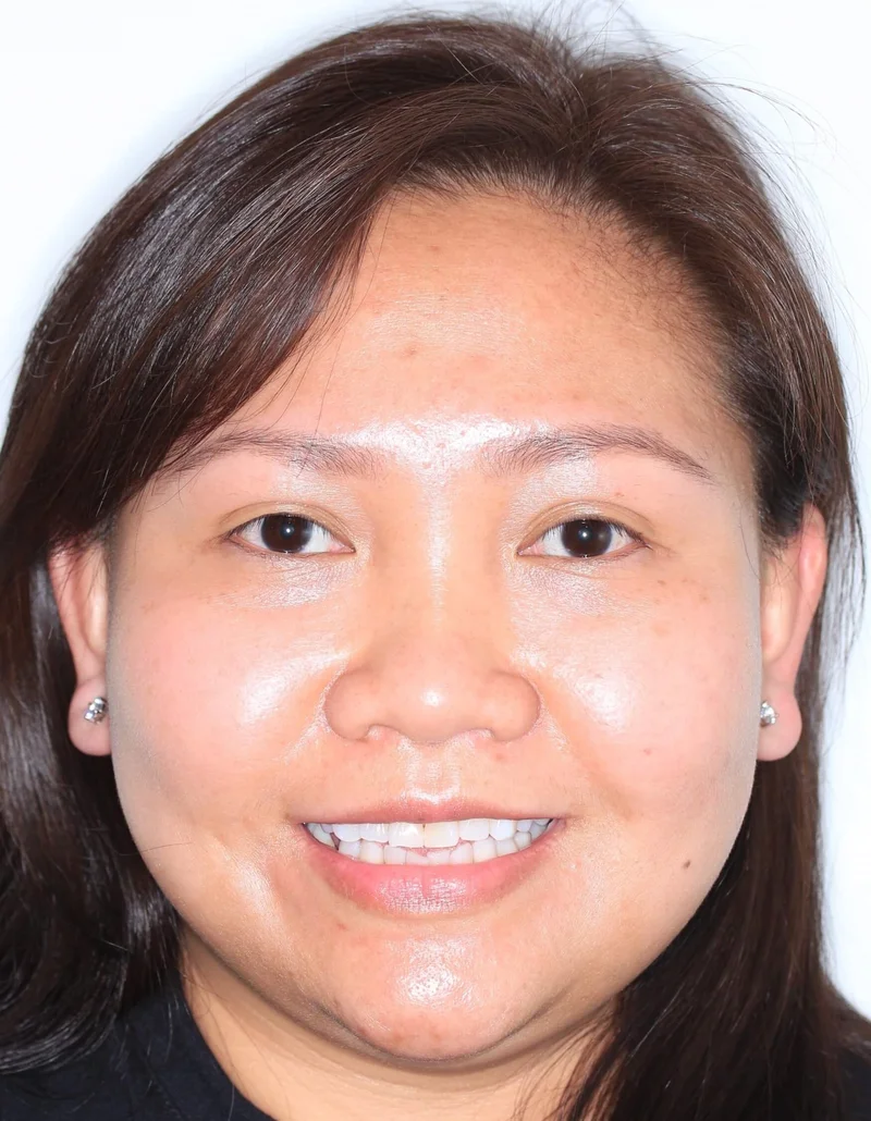 Front Facial Smiling - Before Treatment