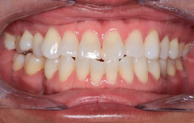 Center - Before Treatment