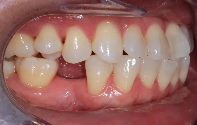 Right Buccal - Before Treatment