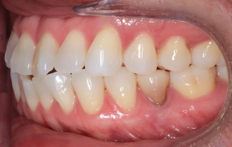 Left Buccal - Before Treatment