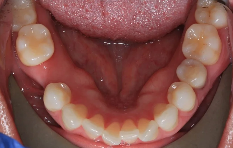 Lower - Before Treatment