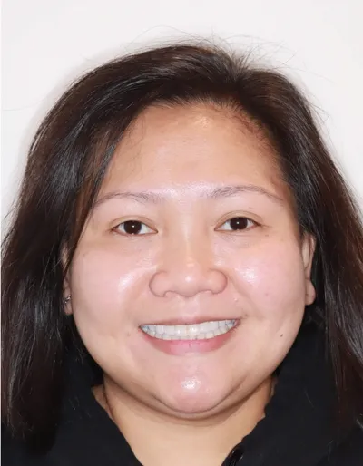 After Metal Braces treatment - Case 95767