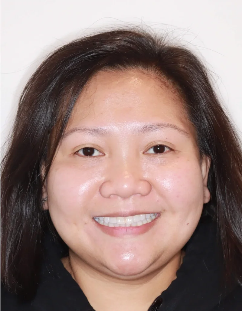 Front Facial Smiling - After Treatment