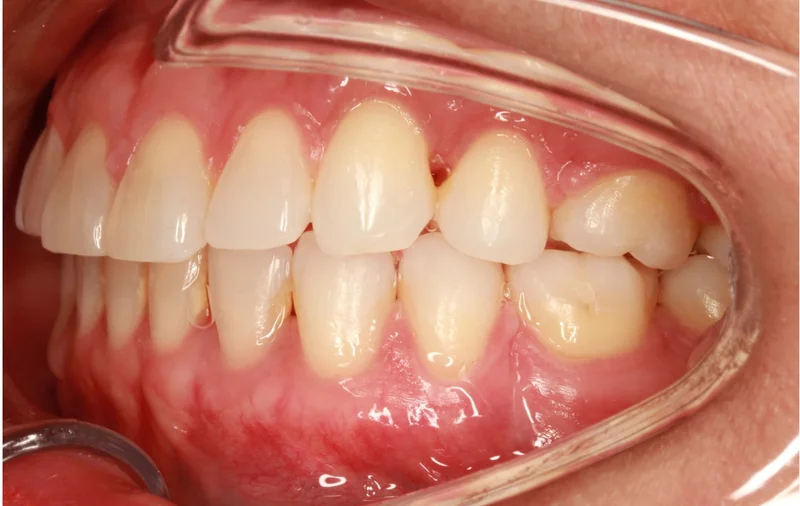 Left Buccal - After Treatment