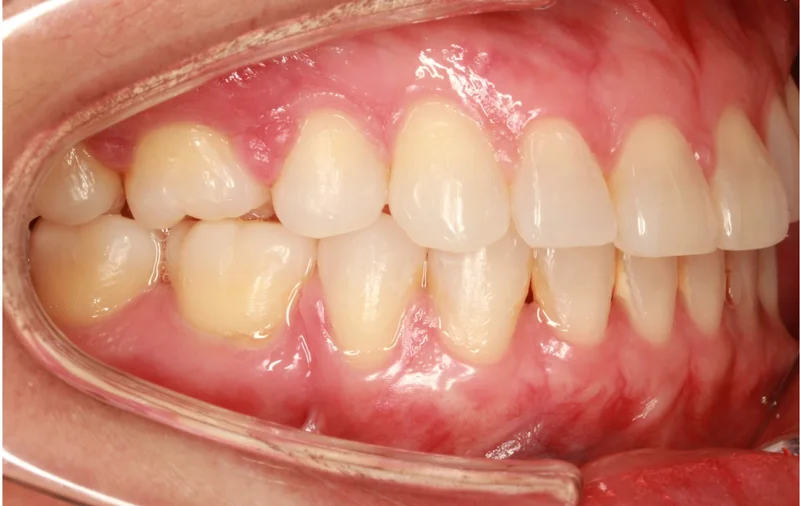 Right Buccal - After Treatment