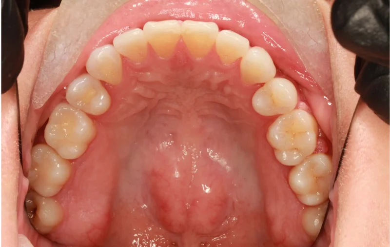 Upper - After Treatment