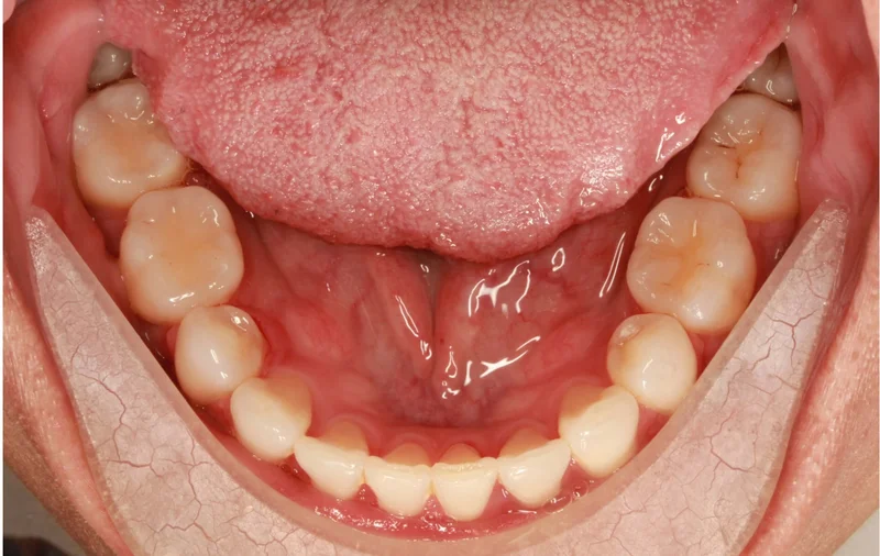 Lower - After Treatment