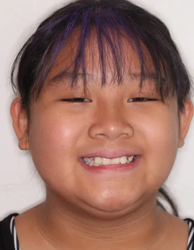 Before Metal Braces treatment - Case 95768