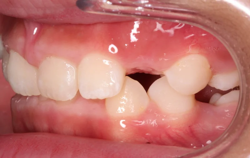 Left - Before Treatment