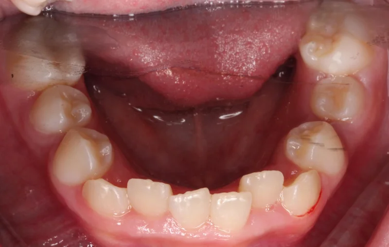 Lower - Before Treatment