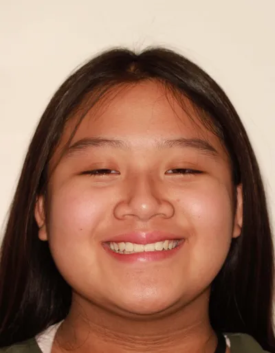 After Metal Braces treatment - Case 95768