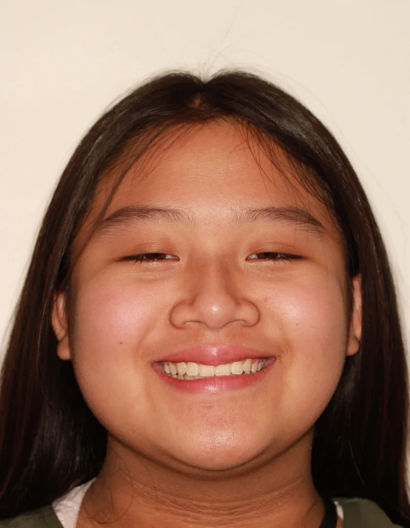 Front Facial Smiling - After Treatment