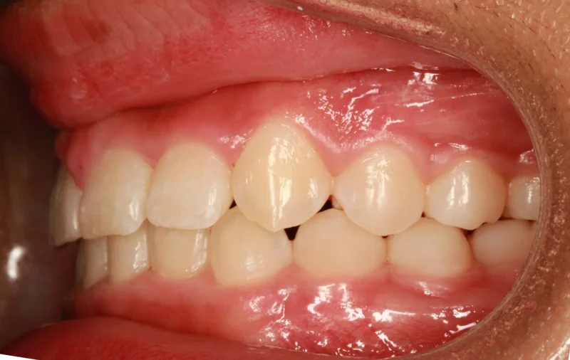 Left - After Treatment