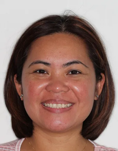 Before Metal Braces treatment - Case 98157