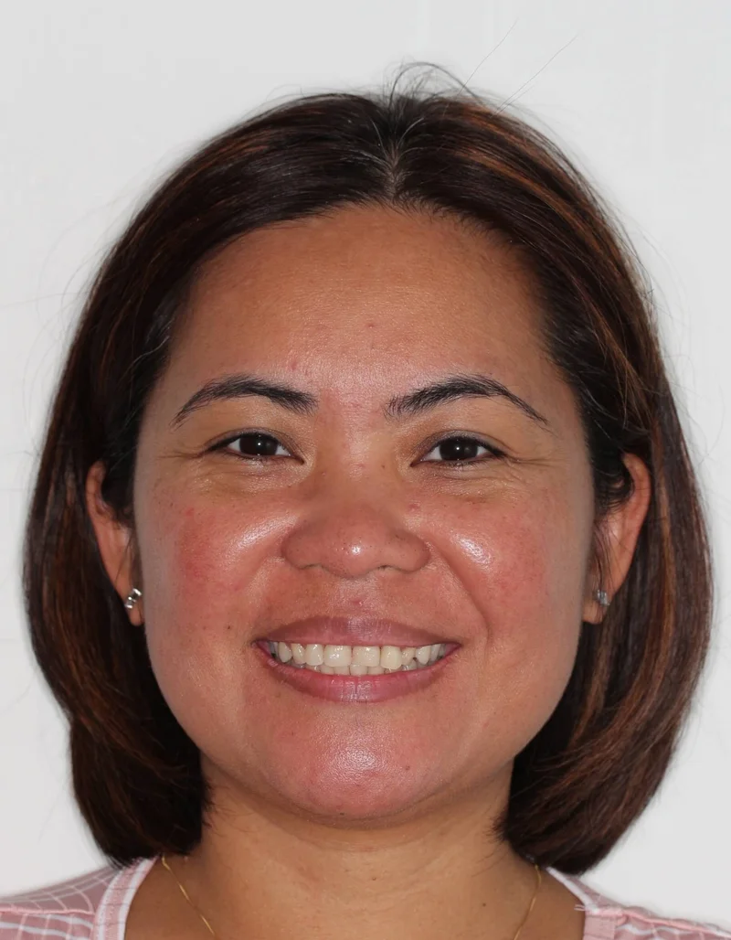 Facial Smiling - Before Treatment