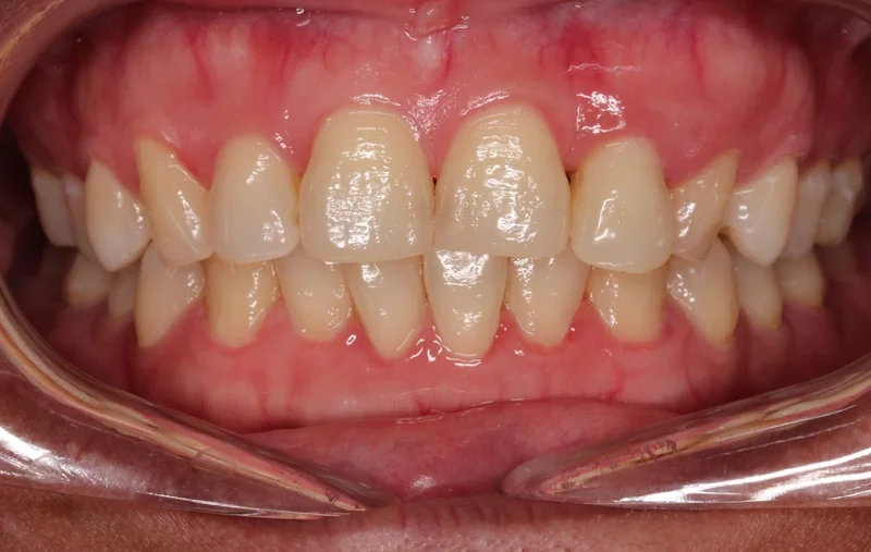 Center - Before Treatment