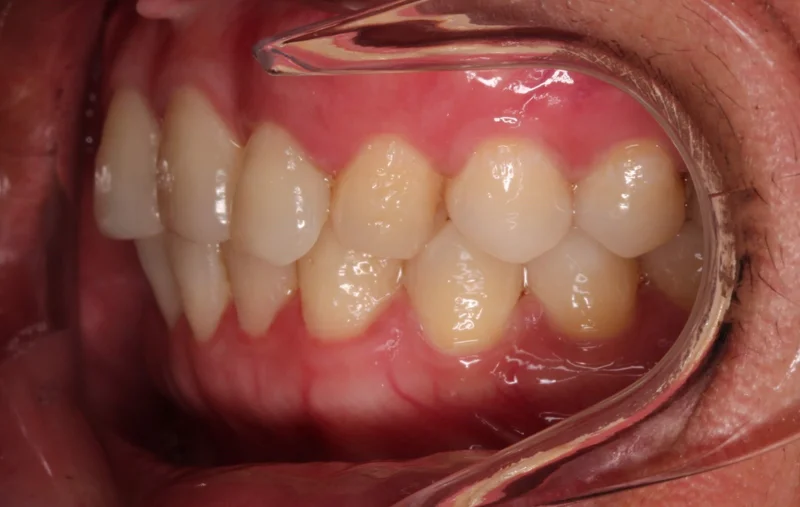 Left - Before Treatment