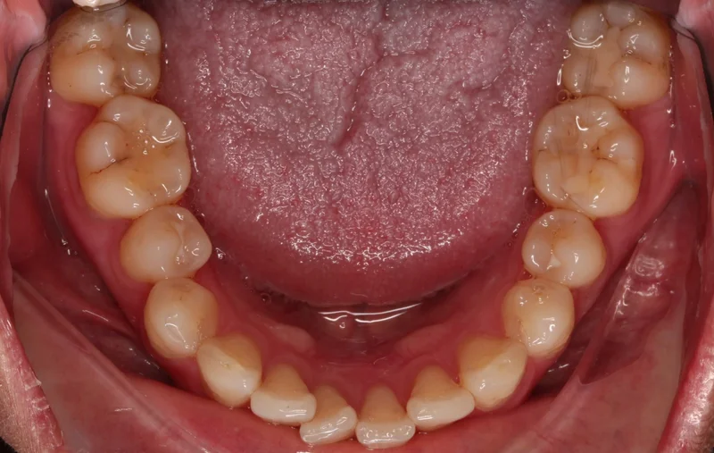 Lower - Before Treatment