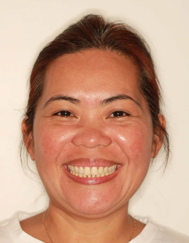 Facial Smiling - After Treatment