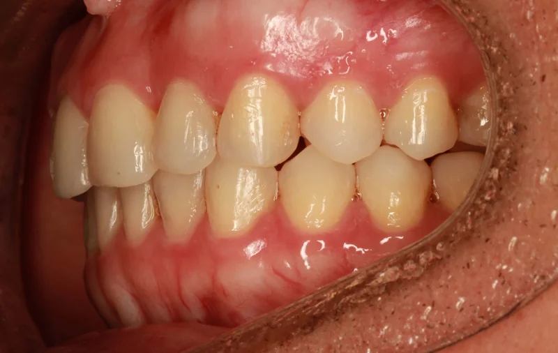 Left - After Treatment