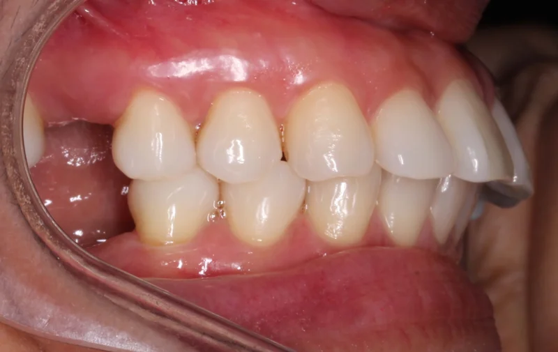 Right Buccal - Before Treatment