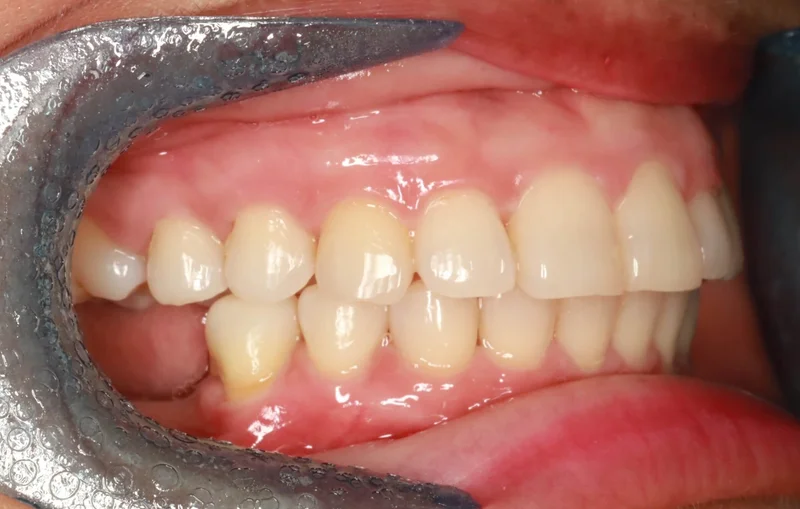 Right Buccal - After Treatment