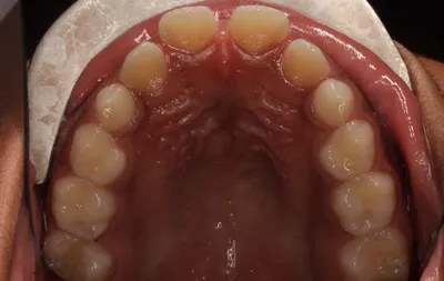 Before Metal Braces treatment - Case 98164