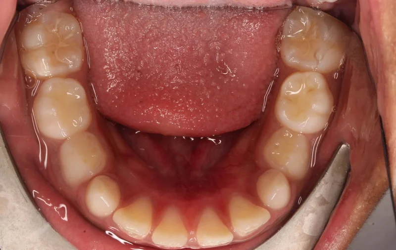 Lower - Before Treatment